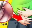 ডিম্বাশয়ে সিস্ট (Cyst) হবার ৮ টি লক্ষণ, যা প্রতিটি মেয়ের জানা দরকার!!!