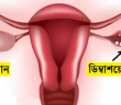 ডিম্বাশয়ে সিস্ট (Cyst) হবার ৮ টি লক্ষণ, যা প্রতিটি মেয়ের জানা দরকার!!!