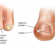 How To Get Rid Of Toenail Fungus Using Just 3 Simple Home Remedies