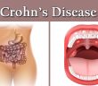 Every Woman Need To Know The Warning Signs of Crohn’s Disease