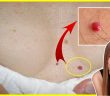 DO YOU HAVE THESE RED SPOTS ON VARIOUS PARTS OF YOUR BODY SHOULD YOU WORRY WHAT SHOULD YOU DO