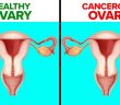 4 Early Symptoms Of Ovarian Cancer That Every Woman Needs To Know