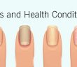 How Your Nails Warn You About Serious Health Conditions