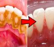 How To Eliminate Tartar, Gingivitis, And Whiten My Teeth In 4 Steps With This Magical Trick