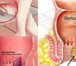 6 Early-Warning Signs of Rectum-Cancer Everyone is TOO Embarrassed to Talk About