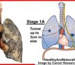 7 Signs of Lung Cancer You Might Be Ignoring