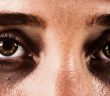 Dark Circles Under The Eyes: Causes, Symptoms, And Treatment Options!