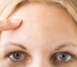 How to Get Rid Of Pimples on Forehead!