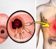 Here Is How to Kill the Bacterium That Causes Heartburn and Bloating!