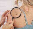 5 Skin Cancer Symptoms You Need to Know This Summer!