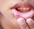 How To Naturally Get Rid Of Canker Sores In Minutes With No Medicine!