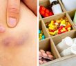 6 Health Problems That Can Cause Bruises On Your Body!